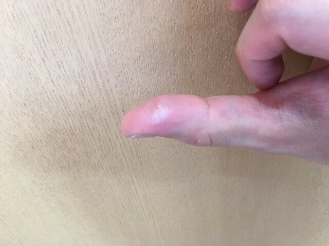 やけど直後の写真