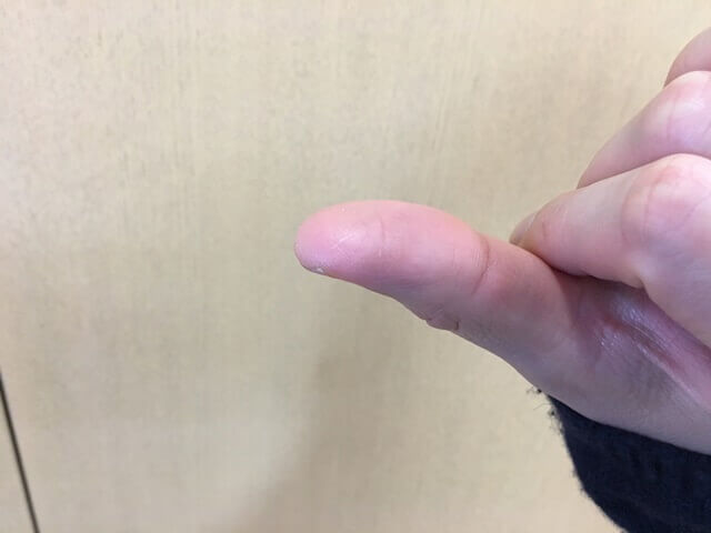 やけど4日目の写真