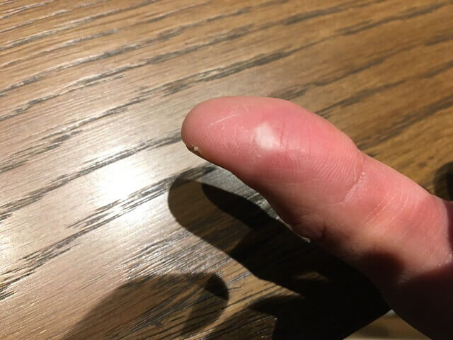 やけど3日目の写真