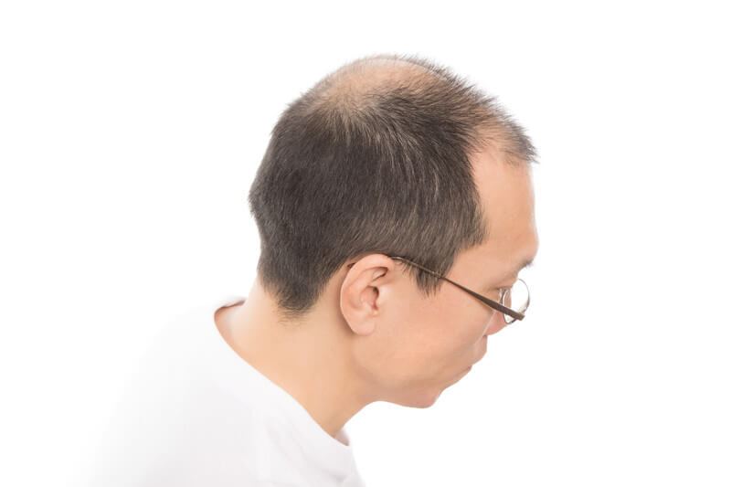 はげた男性の写真