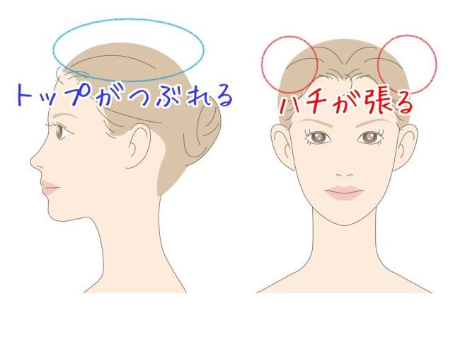 日本人に多い、トップが潰れてハチが張っている頭の写真