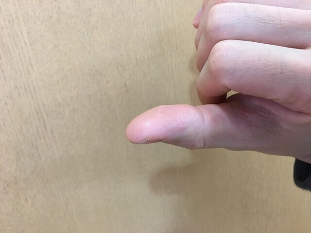 やけど5日目の写真