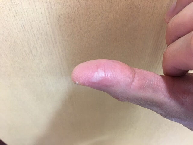 やけど1時間後の写真