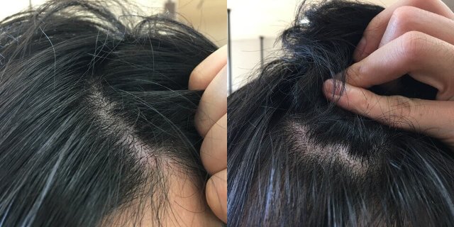 キレイになった頭皮